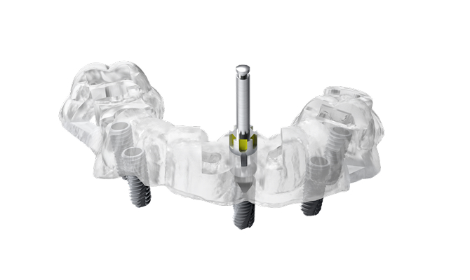 네비게이션 가이드 수술