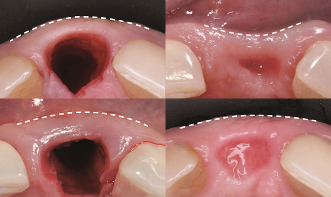 잇몸뼈 손실을 최대한 줄여주는 급속 골이식(i-GBR)